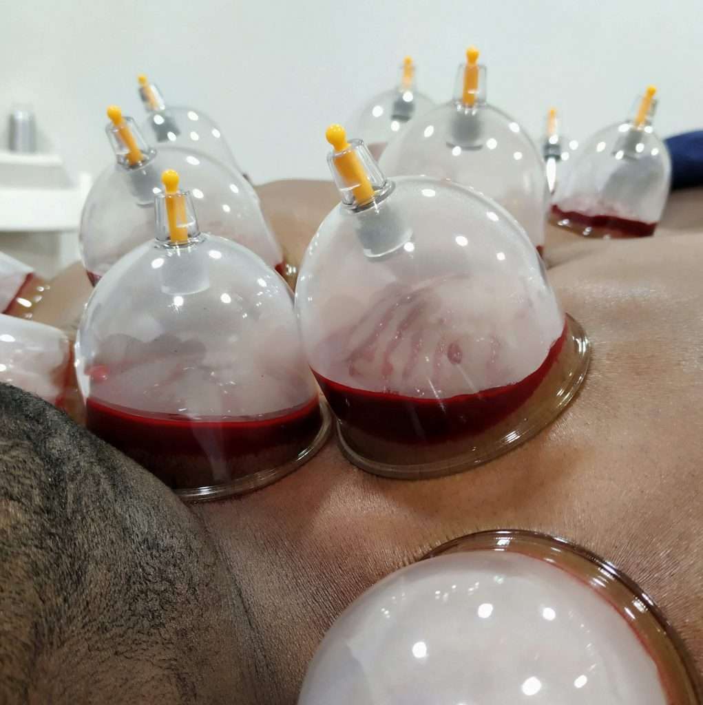 hijama wet cupping